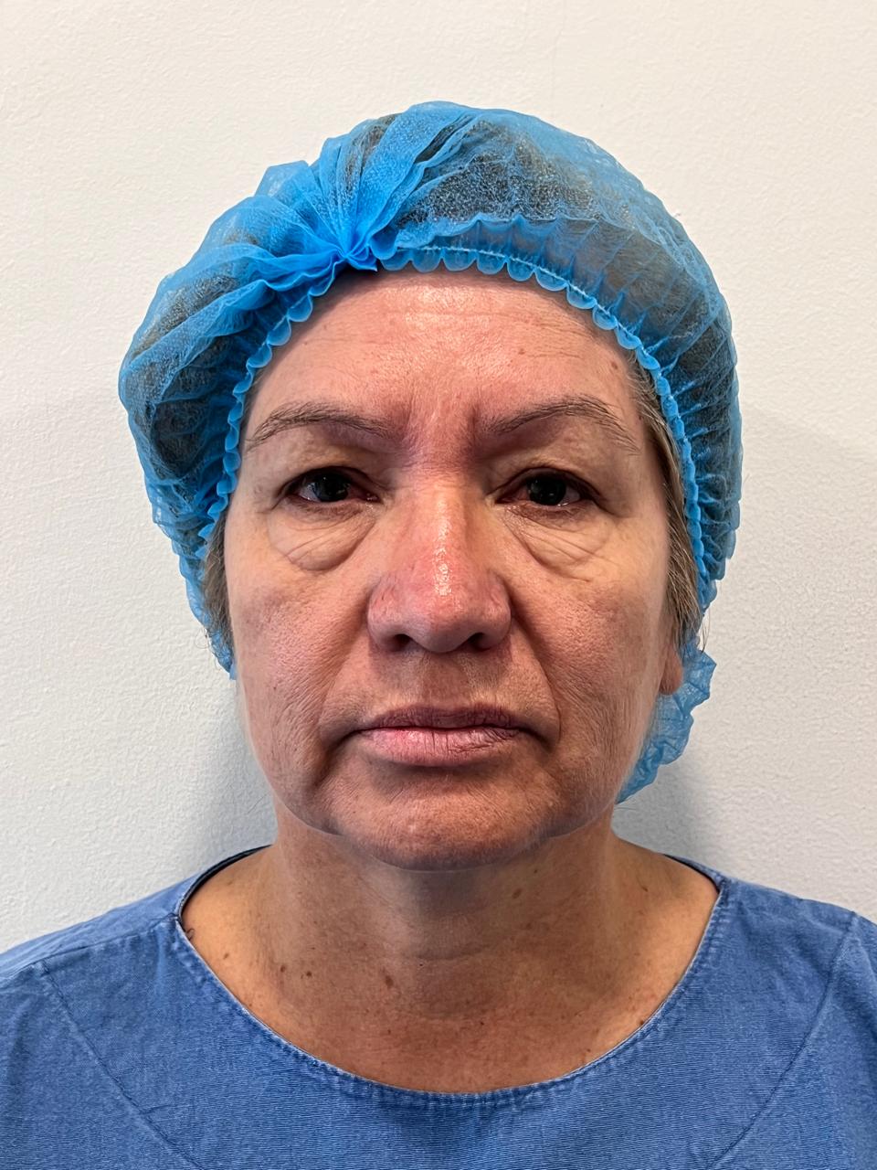 Después blefaroplastia